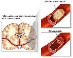 manfaat vitaluxor mencegah-aterosklerosis